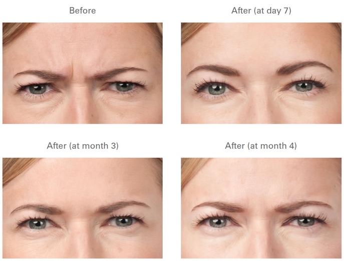 Reduce frown lines with Gravity Medspa